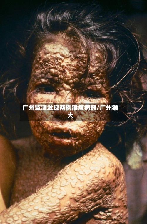 广州监测发现两例猴痘病例/广州猴大-第2张图片